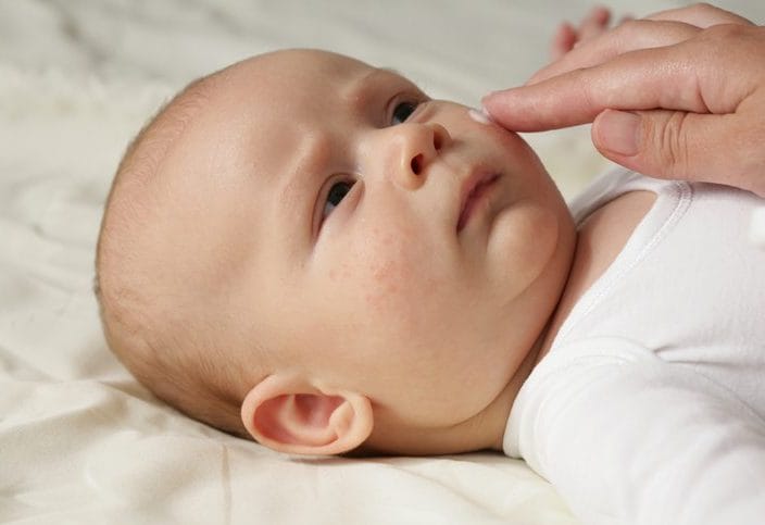 Giving babies under 12 months of age antibiotics increases their risk of developing eczema later in life.